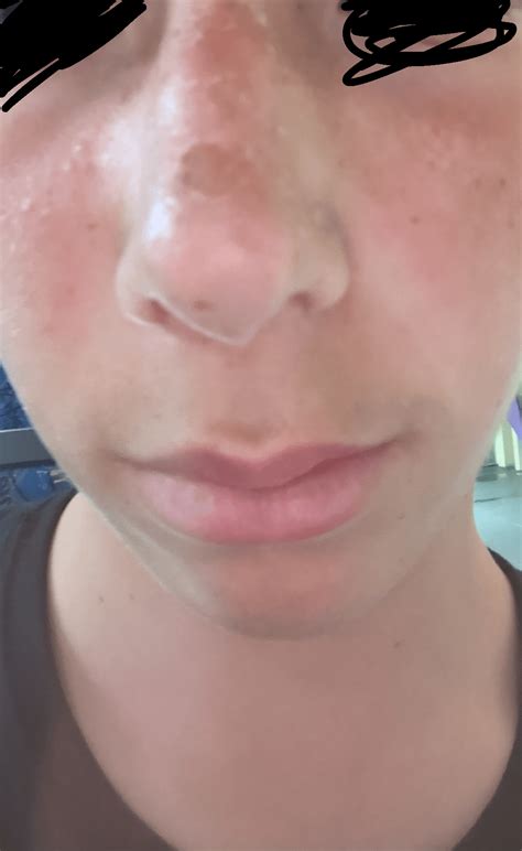 How do I get rid of sunburn peel on my nose I have a date tomorrow : r/Skincare_Addiction