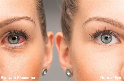 Early Glaucoma Vision