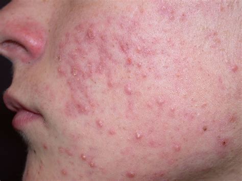 Facial Rashes: What's the Diagnosis?