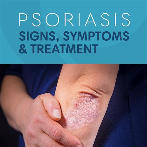 Psoriasis Signs, Symptoms, and Treatment - Optima Dermatology