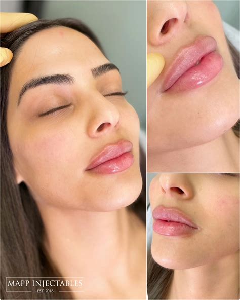 What Does 1Ml Of Lip Filler Look Like at Beth Anker blog