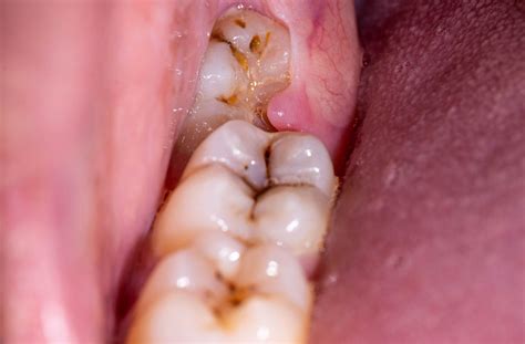 Can a Wisdom Tooth Cause an Abscess? | Marks Dentistry