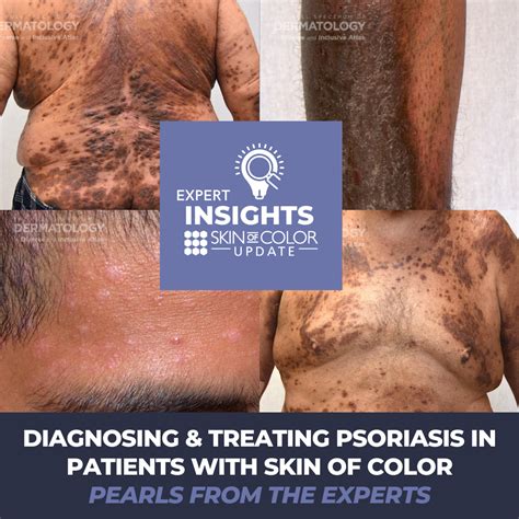 Diagnosing & Treating Psoriasis in Patients with Skin of Color | Pearls from the Experts - Next ...