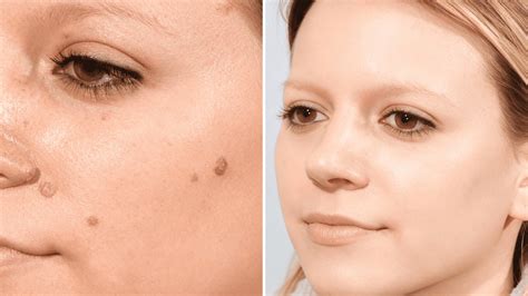 How to Remove Beauty Marks Safely? - Obviousmag