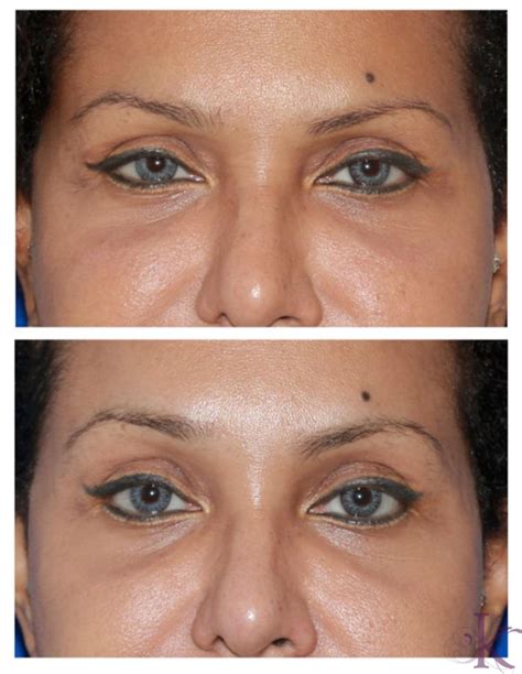 Brow Lift
