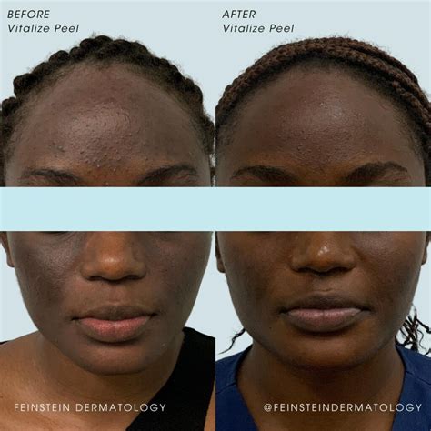 Wrinkled Skin From Sun Damage