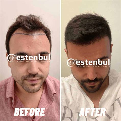 Hair Transplant Istanbul Turkey