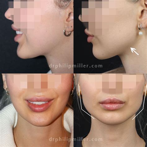 The Advantages of Using Customized Facial Implants - Philip Miller MD