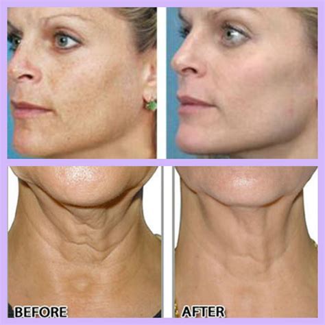 How Much Does Microneedling Cost For Face | ilovemylalaland