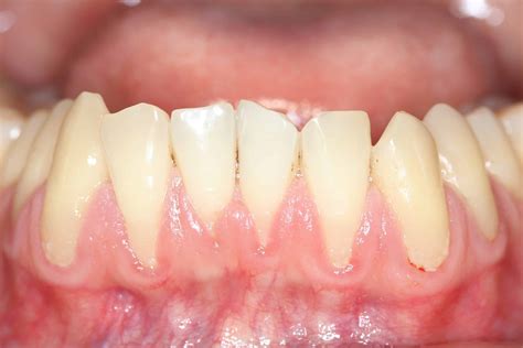 White Spots On Gums
