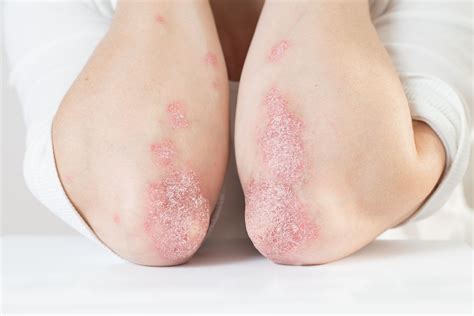 FDA Approves Berdazimer Topical Gel as First Treatment for Molluscum Contagiosum