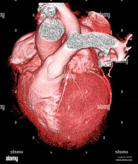 Heart Ct Scan Labeled