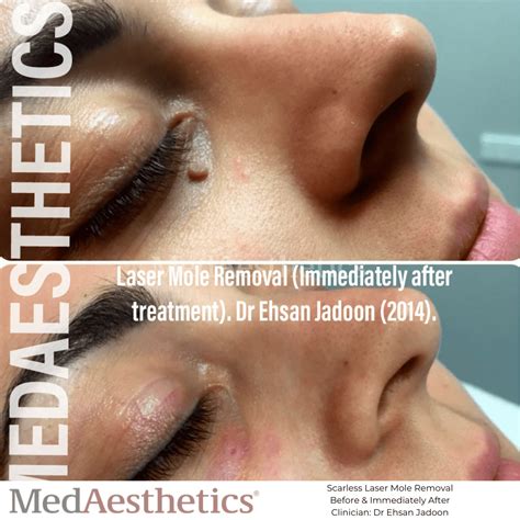 Laser Mole Removal Perth | MedAesthetics