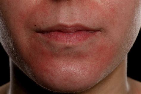 Want To Know Why Your Face Turns Red?