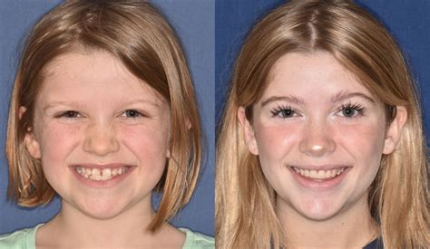 Before & Afters | Parks, Schmit & Fuller Orthodontics