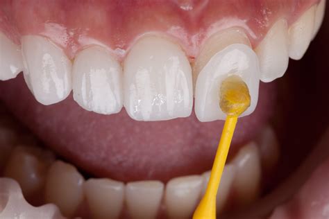 Porcelain Veneers Process