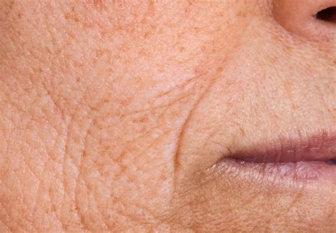 #1 Treatment Best for Crepey Skin in Newport Beach – NeoGen