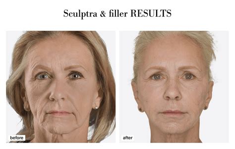 Sculptra Before And After