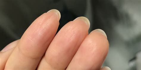 Painful Skin Around Fingernails
