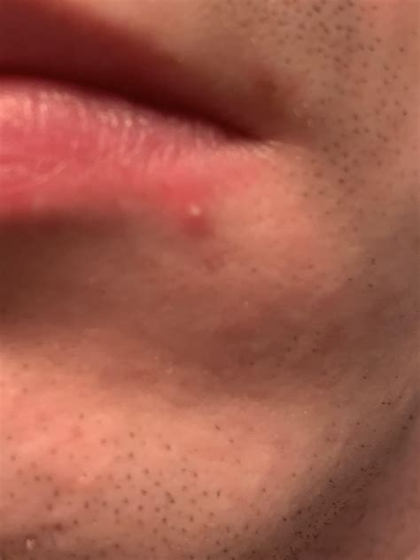 Cold Sore Vs Pimple