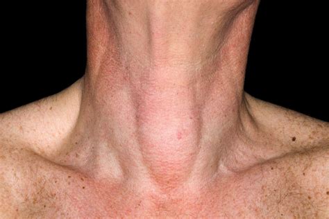 Cancerous Lumps On Neck