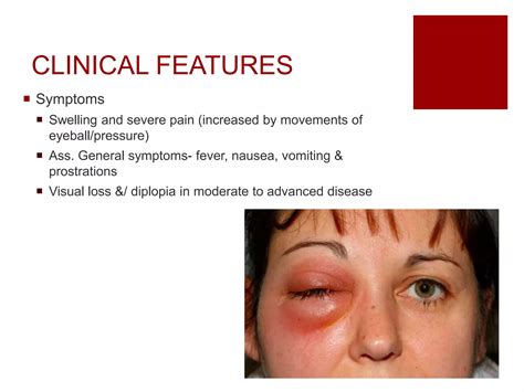 Orbital Cellulitis Symptoms