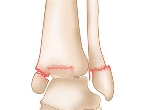 Medial Malleolus Fracture