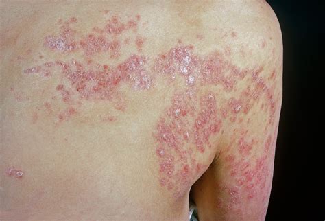 Psoriasis On Back