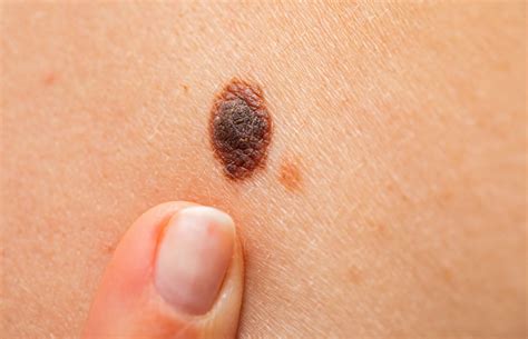 Pictures of cancerous moles: early stage, cancerous moles images, pictures of skin moles ...
