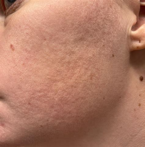 Face goosebumps after starting XYWAV? : r/Xywav