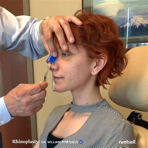 8 rhinoplasty recovery rules you should always follow after surgery – Artofit