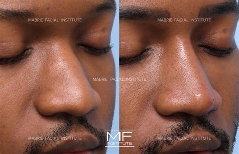 Your Top Non Surgical Nose Job Questions, Answered Mabrie Facial ...