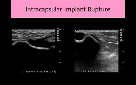 Breast Ultrasound Registry Review Course