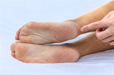 Dry Skin On Feet