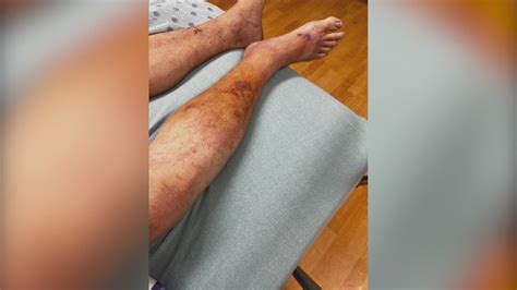 Researchers working on new drug to treat flesh-eating bacteria | khou.com