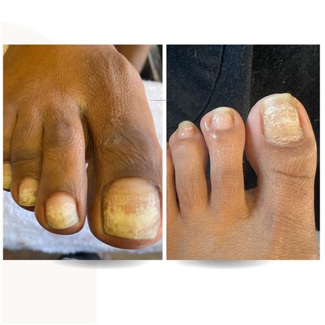 White Spots On Toenails: Its Nature, Causes, Prevention – QLZCB