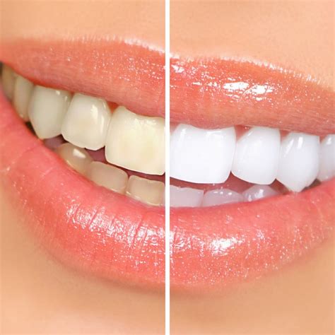 Estética dental