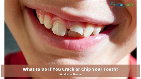 What to Do If You Crack or Chip Your Tooth? - Kirkland Premier Dentistry