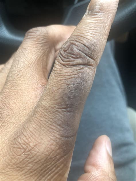 Weird black spots on finger : r/SkincareAddicts