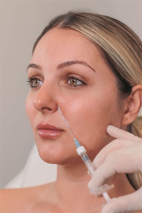 Nasolabial Folds Filler Treatment – MovMore Clinic