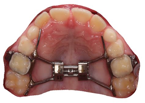 Rapid Palatal Expander (Palate Expander) - Yang Orthodontics