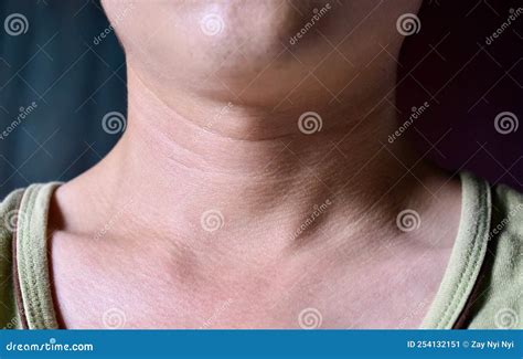 Aging Skin Folds or Skin Creases or Wrinkles at Neck of Asian Young Man Stock Image - Image of ...