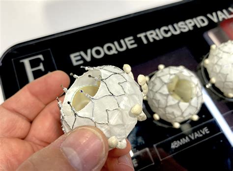 CMS approves Medicare coverage for transcatheter tricuspid valve replacement