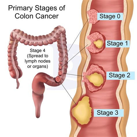 Stages Of Colon Polyps