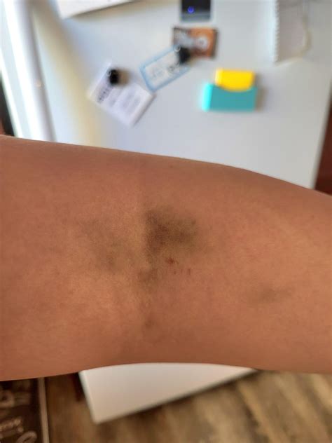 My vein collapsed while donating plasma earlier this week. Here's how ...