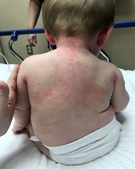 Dairy Allergy Breastfed Baby Rash at Kiara Cann blog