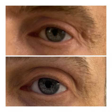 Eye Lift Wand – Topical Eye Lift Treatment Serum | SBLA Beauty