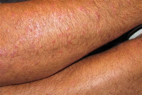 Polymorphic Light Eruption Face Facial Pityriasis Alba, Polymorphous