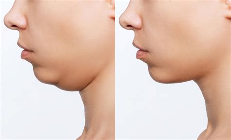 KYBELLA® Double Chin Treatment in Torrance, CA — Lumier Medical