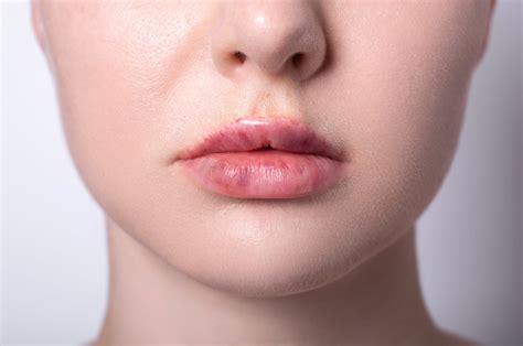 Lip Filler Migration: How to Fix and Prevent | IIAM